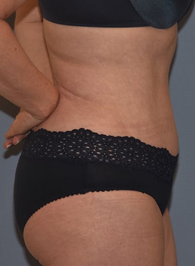 Tummy Tuck Before & After Gallery - Patient 777381 - Image 6