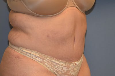 Mommy Makeover Before & After Gallery - Patient 193465 - Image 4