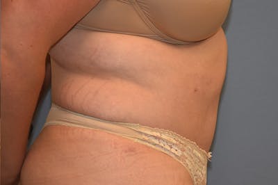 Mommy Makeover Before & After Gallery - Patient 193465 - Image 6