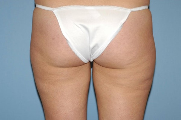 Liposuction Before & After Gallery - Patient 207594 - Image 1