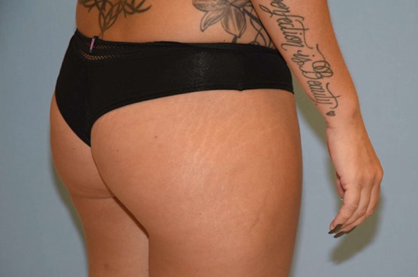 Brazilian Butt Lift Before & After Gallery - Patient 236914 - Image 3