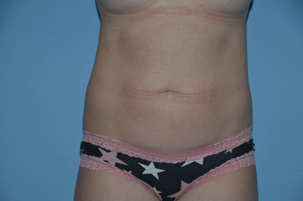 Before and After of Mommy Makeover in Long Island