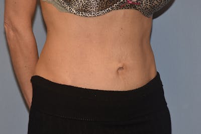 Tummy Tuck Before & After Gallery - Patient 243337 - Image 4