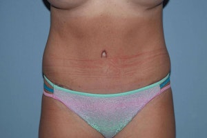 Before and After of Mommy Makeover in Long Island