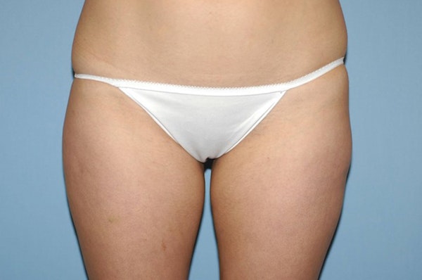 Liposuction Before & After Gallery - Patient 207594 - Image 3