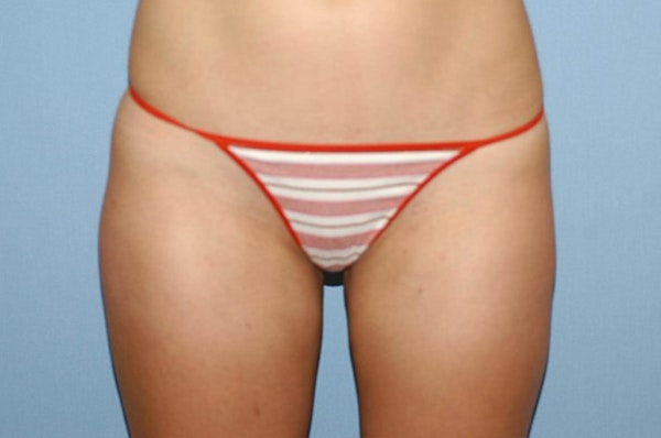 Liposuction Before & After Gallery - Patient 207594 - Image 4