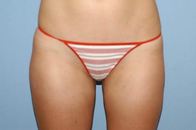 Liposuction Before & After Gallery - Patient 207594 - Image 4