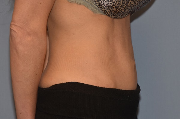 Tummy Tuck Before & After Gallery - Patient 243337 - Image 6