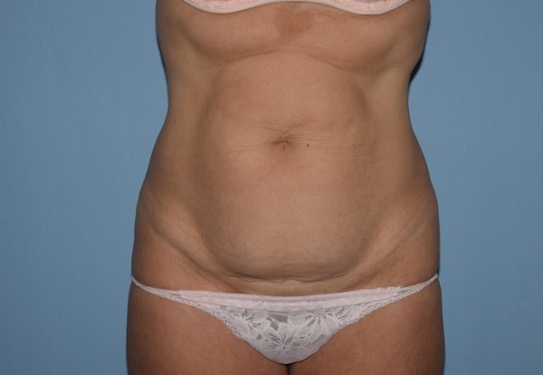 Tummy Tuck Before & After Gallery - Patient 451872 - Image 1