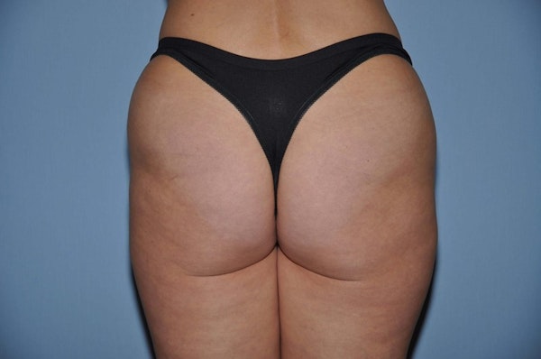 Brazilian Butt Lift Before & After Gallery - Patient 144579 - Image 1