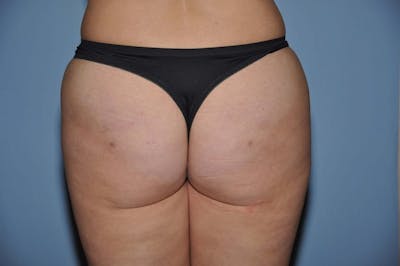 Brazilian Butt Lift Before & After Gallery - Patient 144579 - Image 2