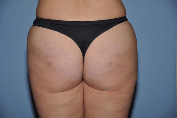 Brazilian Butt Lift Before & After Gallery - Patient 144579 - Image 2