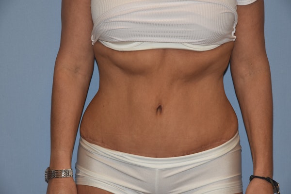 Tummy Tuck Before & After Gallery - Patient 451872 - Image 2