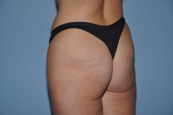 Brazilian Butt Lift Before & After Gallery - Patient 144579 - Image 3