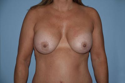 Mommy Makeover Before & After Gallery - Patient 176229 - Image 2