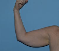 Arm Lift Before & After Gallery - Patient 373881 - Image 1