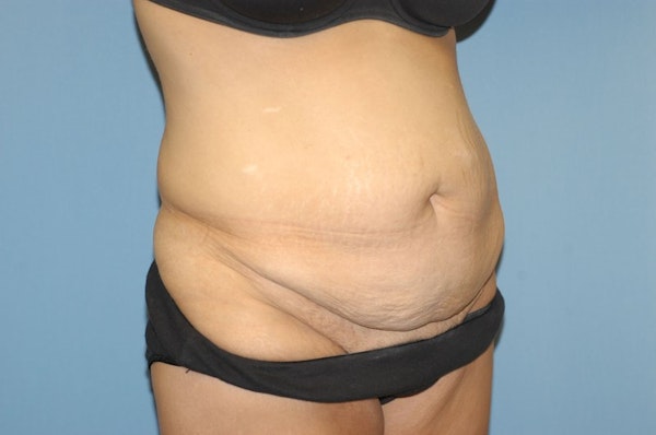 After Weight Loss Surgery Before & After Gallery - Patient 272147 - Image 3