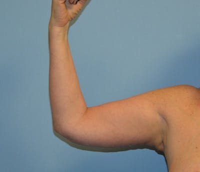 Arm Lift Before & After Gallery - Patient 373881 - Image 2