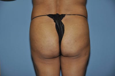 Brazilian Butt Lift Before & After Gallery - Patient 697009 - Image 1