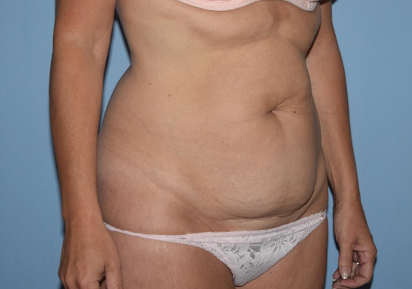Tummy Tuck Before & After Gallery - Patient 451872 - Image 3