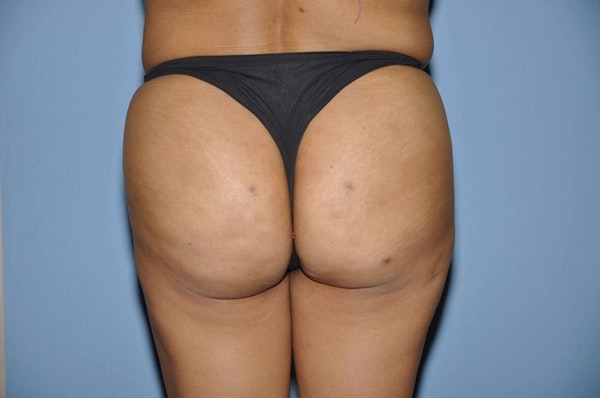 Brazilian Butt Lift Before & After Gallery - Patient 697009 - Image 2