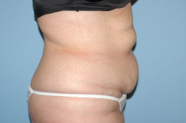 Liposuction Before & After Gallery - Patient 233624 - Image 5