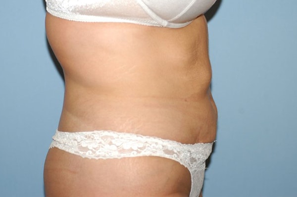 Liposuction Before & After Gallery - Patient 233624 - Image 6