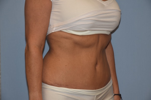 Tummy Tuck Before & After Gallery - Patient 451872 - Image 4