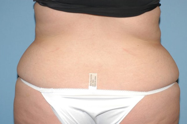 Liposuction Before & After Gallery - Patient 233624 - Image 7