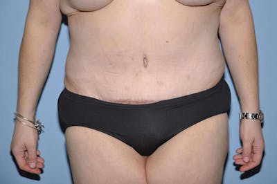 After Weight Loss Surgery Before & After Gallery - Patient 170310 - Image 2