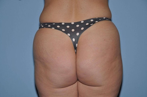 Brazilian Butt Lift Before & After Gallery - Patient 323758 - Image 1
