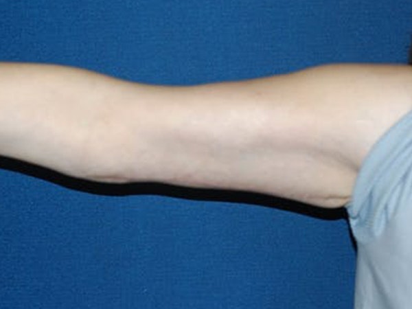 Arm Lift Before & After Gallery - Patient 346748 - Image 4
