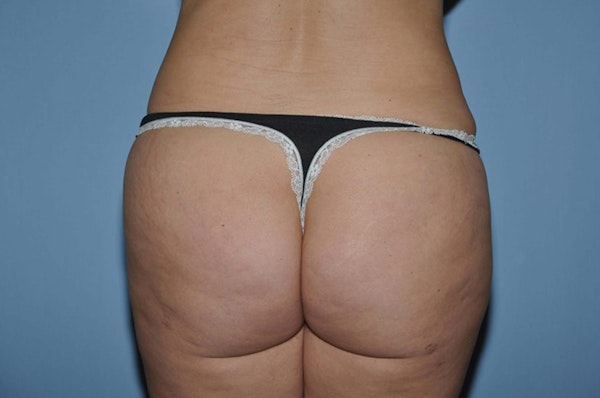 Brazilian Butt Lift Before & After Gallery - Patient 323758 - Image 2