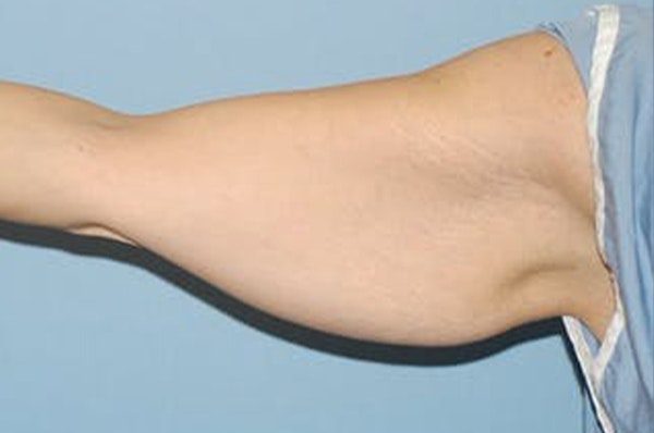 Arm Lift Before & After Gallery - Patient 236913 - Image 1