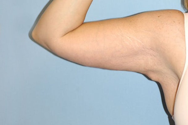 Arm Lift Before & After Gallery - Patient 236913 - Image 2