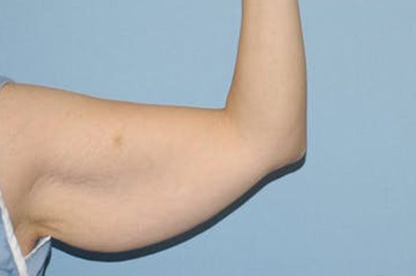 Arm Lift Before & After Gallery - Patient 236913 - Image 3
