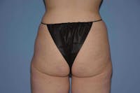 Brazilian Butt Lift Before & After Gallery - Patient 295570 - Image 1