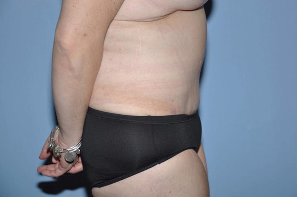 After Weight Loss Surgery Before & After Gallery - Patient 170310 - Image 6