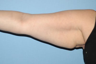 Arm Lift Before & After Gallery - Patient 404447 - Image 1