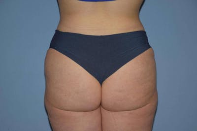 Brazilian Butt Lift Before & After Gallery - Patient 295570 - Image 2