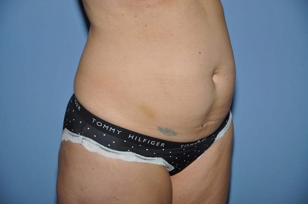 Mommy Makeover Before & After Gallery - Patient 115470 - Image 7