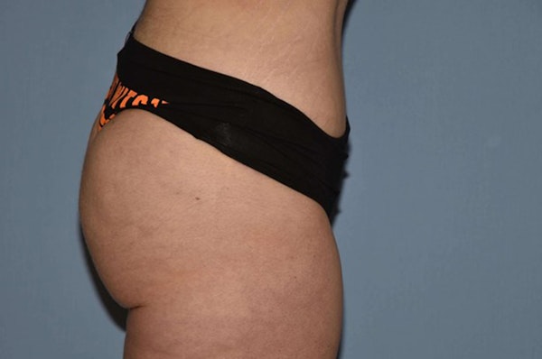 Liposuction Before & After Gallery - Patient 411966 - Image 6