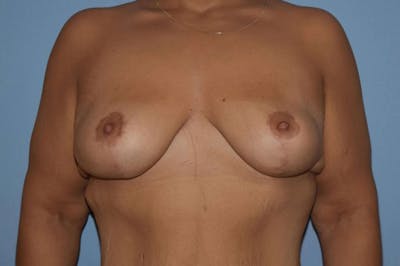 After Weight Loss Surgery Before & After Gallery - Patient 300299 - Image 2