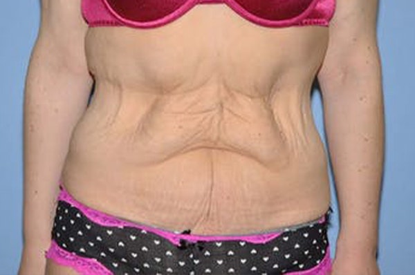 After Weight Loss Surgery Before & After Gallery - Patient 221347 - Image 1