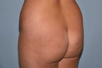 Brazilian Butt Lift Before & After Gallery - Patient 406455 - Image 1