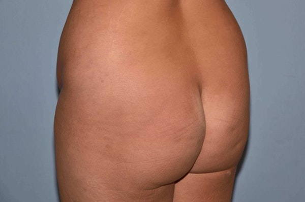 Brazilian Butt Lift Before & After Gallery - Patient 406455 - Image 1