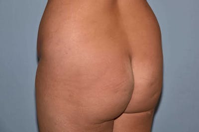 Brazilian Butt Lift Before & After Gallery - Patient 406455 - Image 1