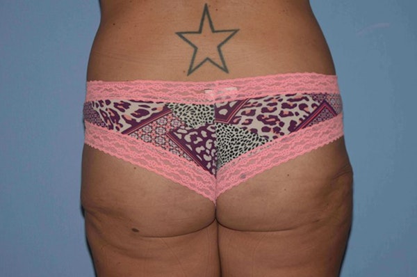 Liposuction Before & After Gallery - Patient 352306 - Image 2