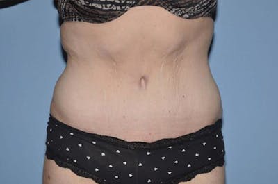 After Weight Loss Surgery Before & After Gallery - Patient 221347 - Image 2
