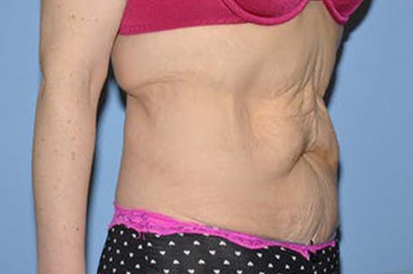 After Weight Loss Surgery Before & After Gallery - Patient 221347 - Image 3
